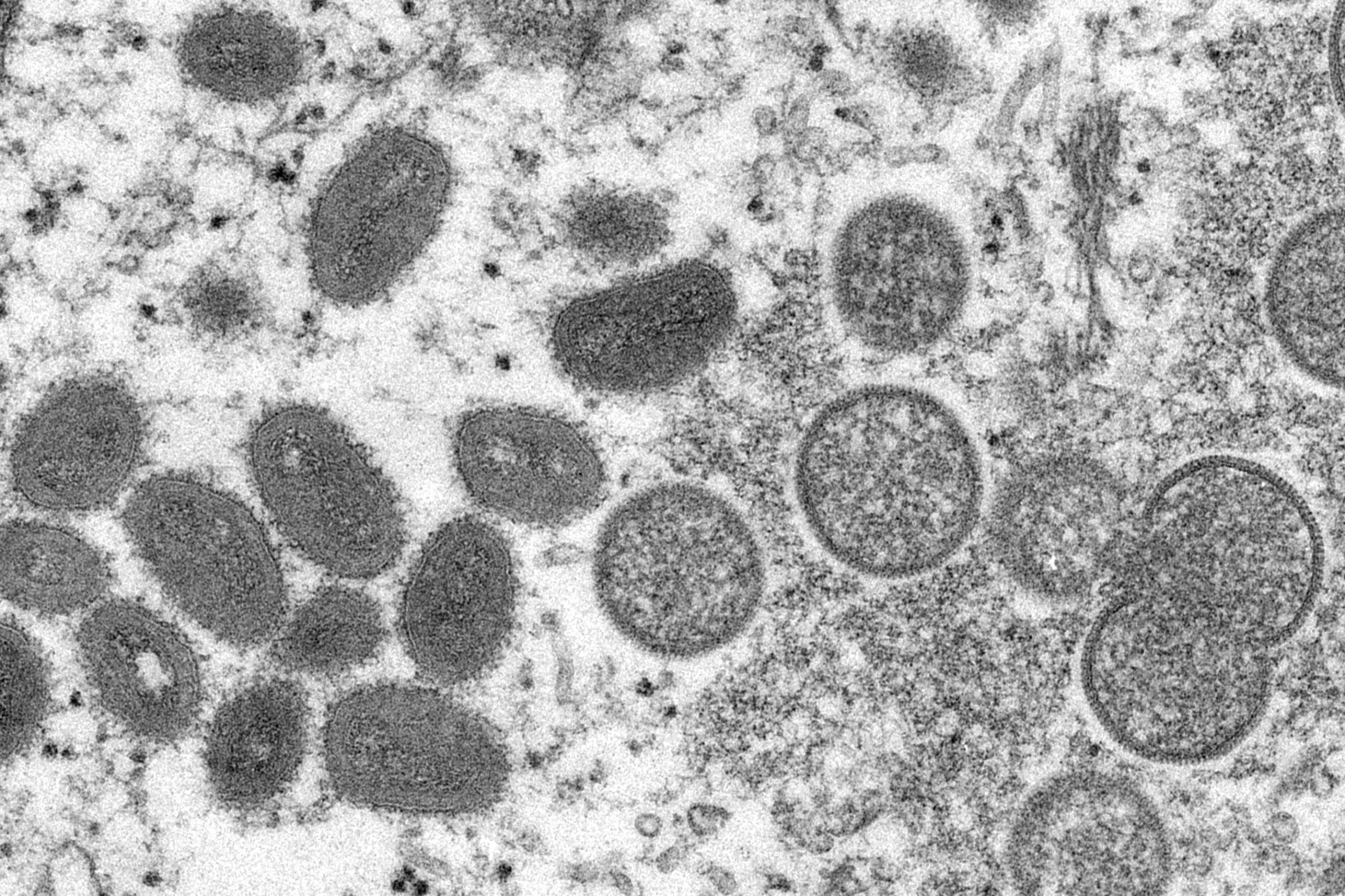 New York City resident tests positive for monkeypox virus