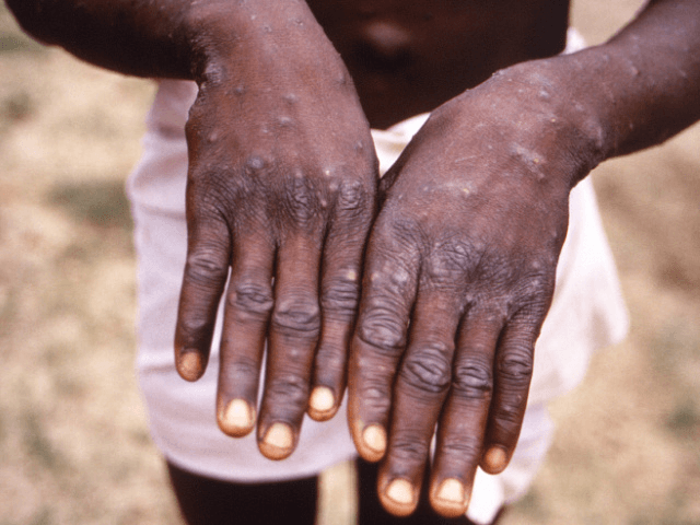 Report: Suspected New York City Monkeypox Case Awaits CDC Confirmation